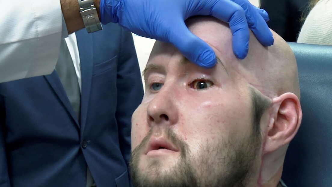 Хирурзи у Њујорку извршили прву трансплантацију ока у свету