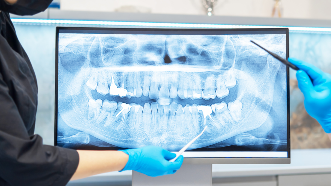 Otkriven lek zahvaljujući kome će ljudima nicati treći zubi: Prvo testiranje već u septembru