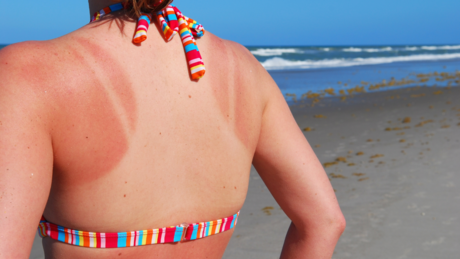 Опекотине од сунца нису увек безопасне: Два знака да вам је потребан лекар