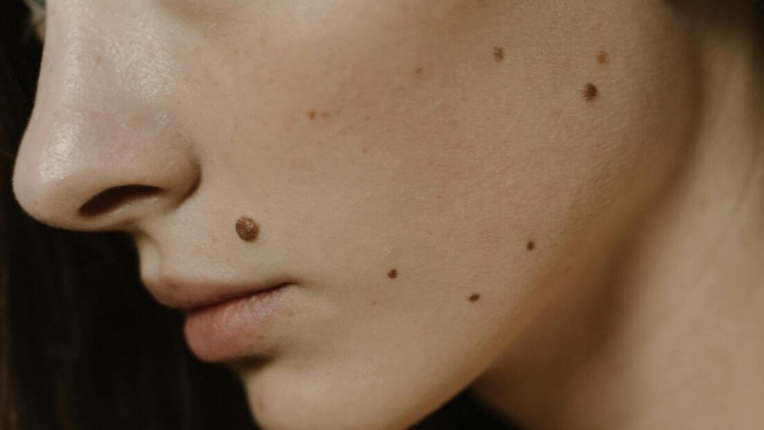 Зашто неки људи имају много младежа - како их заштитити од сунца