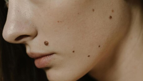 Зашто неки људи имају много младежа - како их заштитити од сунца