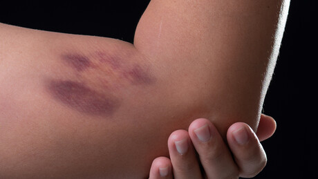 Колико је времена потребно да модрица нестане