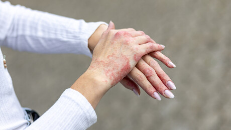 Prirodan lek: Sunčanje može imati pozitivan efekat na psorijazu